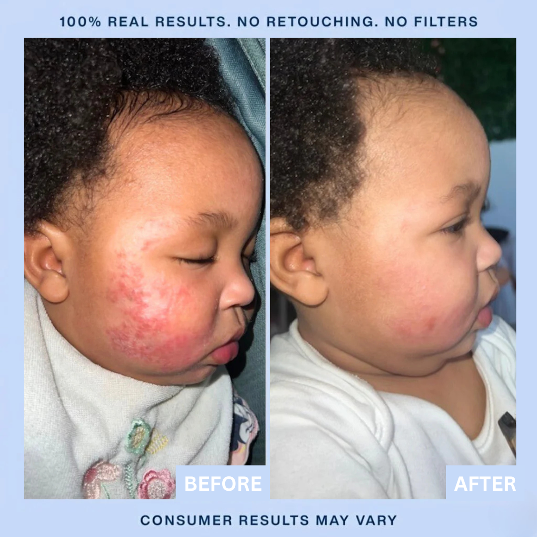 Neova™ Eczema & Psoriasis Cream